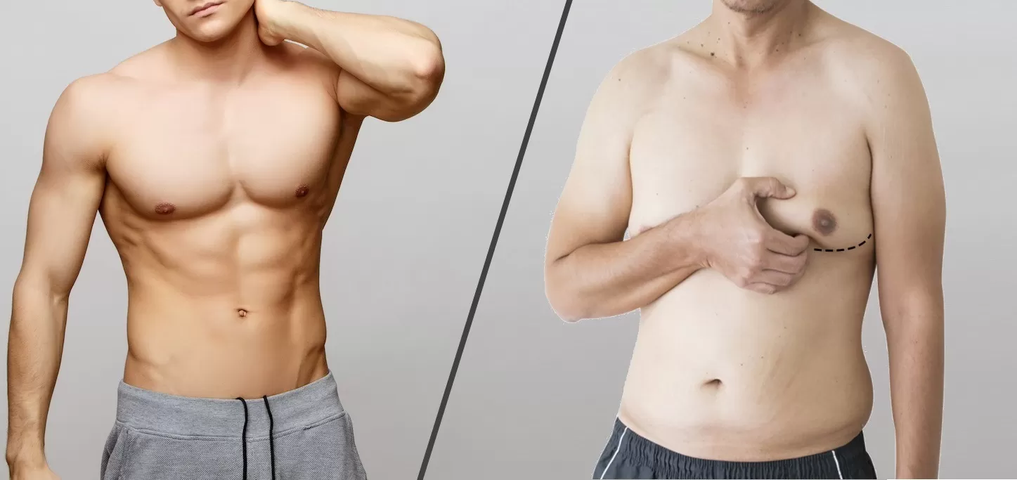 Comment se débarrasser de la graisse des pectoraux ?
