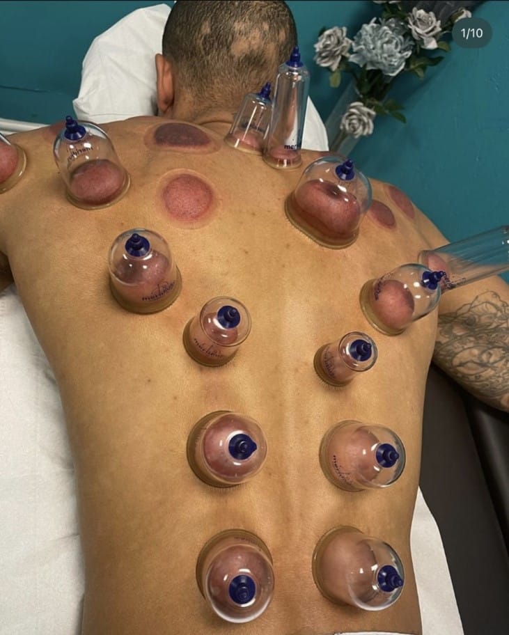 Ventouses dos : bienfaits, récupération et cupping sportif cupping sportif